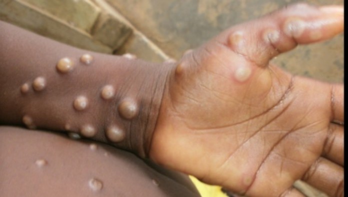 ABD’de Monkeypox virüsü alarmı…