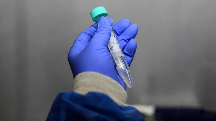 KKTC’de bugün 93’ü yerel 113 pozitif vaka 170 taburcu